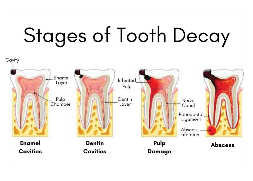 A Guide To Abscess Tooth Stages Take Home Smile