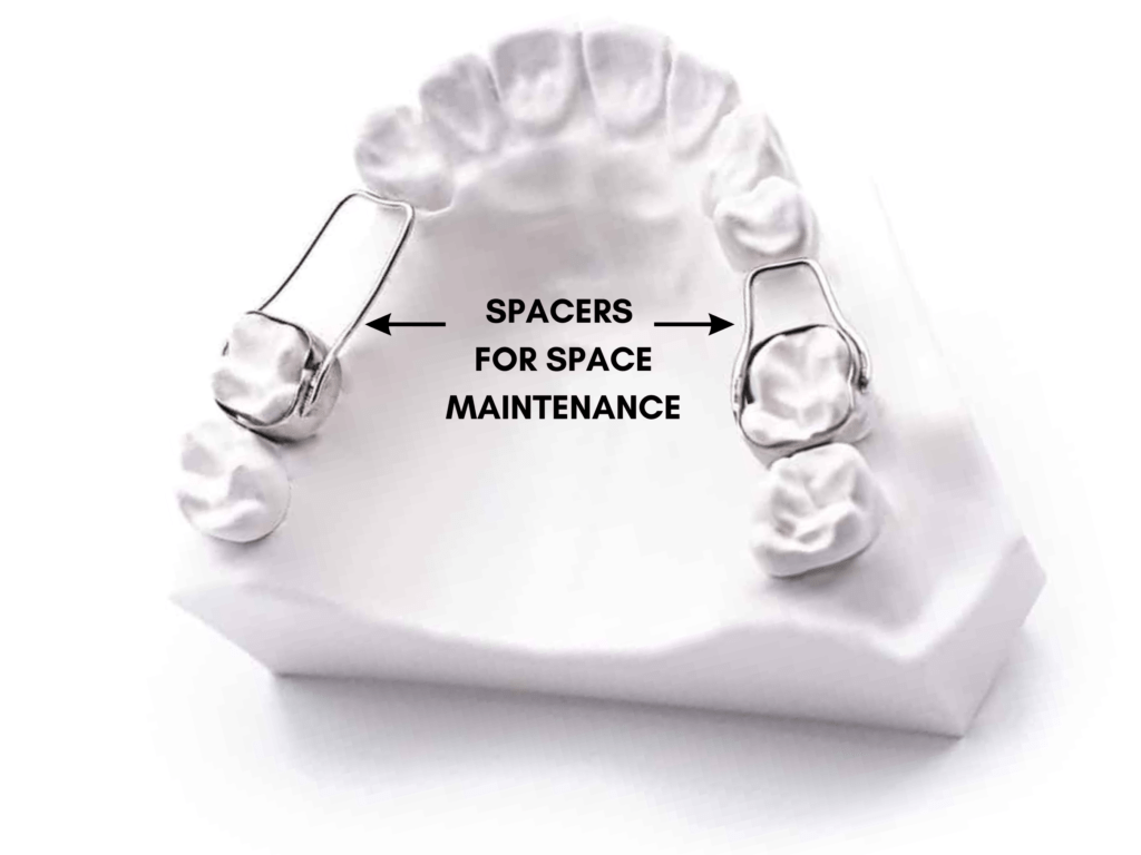 What Are the Types of Spacers for Children's Teeth? - Take Home Smile