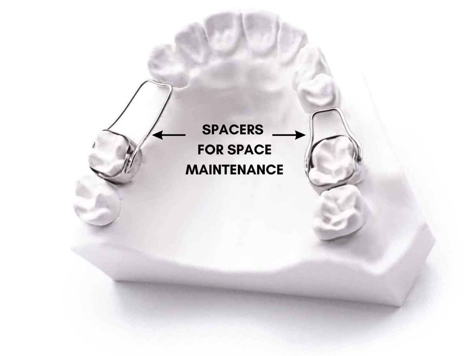 What Are the Types of Spacers for Children's Teeth? Take Home Smile