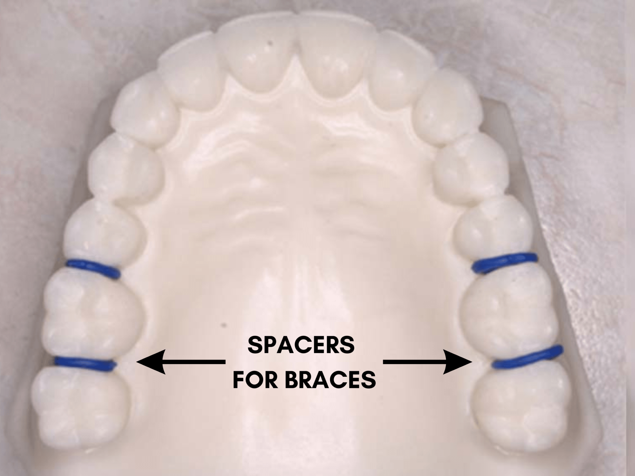 What Are The Types Of Spacers For Children S Teeth Take Home Smile   SPACERS FOR BRACES 2048x1536 