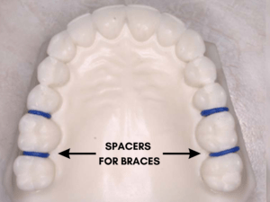 spacers for children's teeth